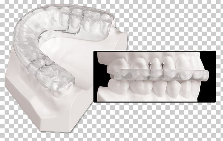 Mandibular Advancement Splint Dentistry Jaw Temporomandibular Joint Dysfunction PNG, Clipart, Angle, Dentistry, Dual, Incisor, Jaw Free PNG Download