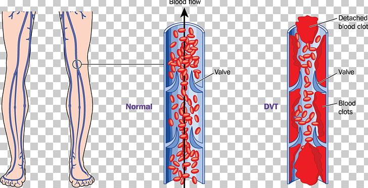 Deep Vein Thrombosis Thrombus PNG, Clipart, Arm, Artery, Blood, Blood Vessel, Coagulation Free PNG Download