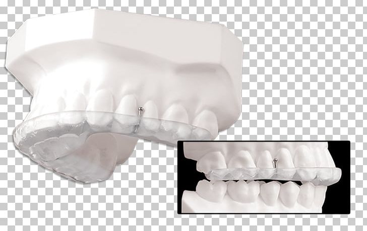 Splint Tooth Temporomandibular Joint Dysfunction Therapy PNG, Clipart, Canine Tooth, Jaw, Maxilla, Neuromuscular Disease, Occlusal Splint Free PNG Download