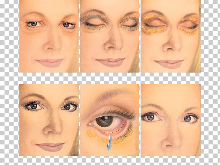 Blepharoplasty Eyelid Surgery Periorbital Puffiness PNG, Clipart, Beauty, Blepharoplasty, Cheek, Chin, Cosmetics Free PNG Download