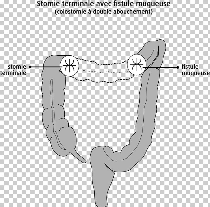 Large Intestine Ileostomy Colostomy Rectum Colorectal Cancer PNG, Clipart, Abdomen, Anatomy, Angle, Arm, Black And White Free PNG Download