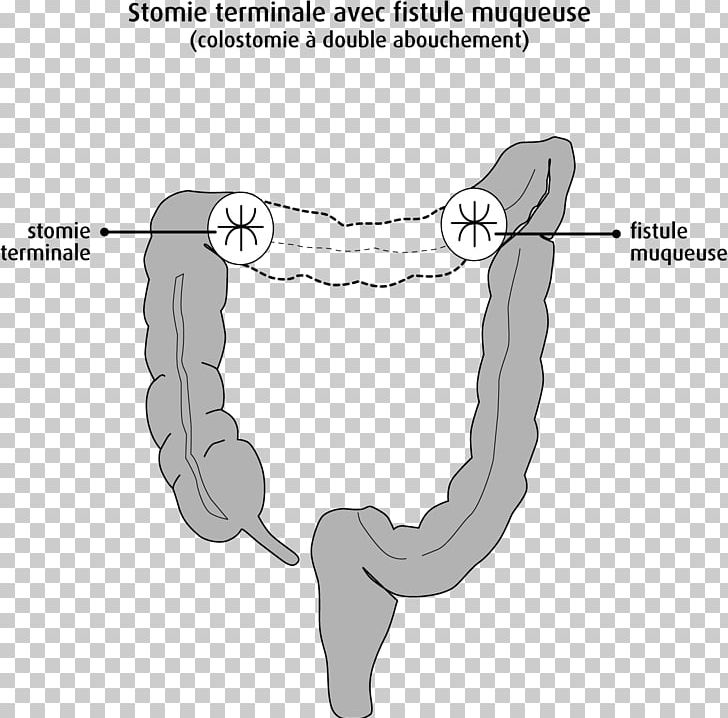 Large Intestine Ileostomy Colostomy Rectum Colorectal Cancer PNG ...