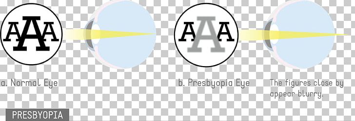 Astigmatism Eye Disease Visual Perception Amblyopia PNG, Clipart, Amblyopia, Angle, Area, Astigmatism, Brand Free PNG Download