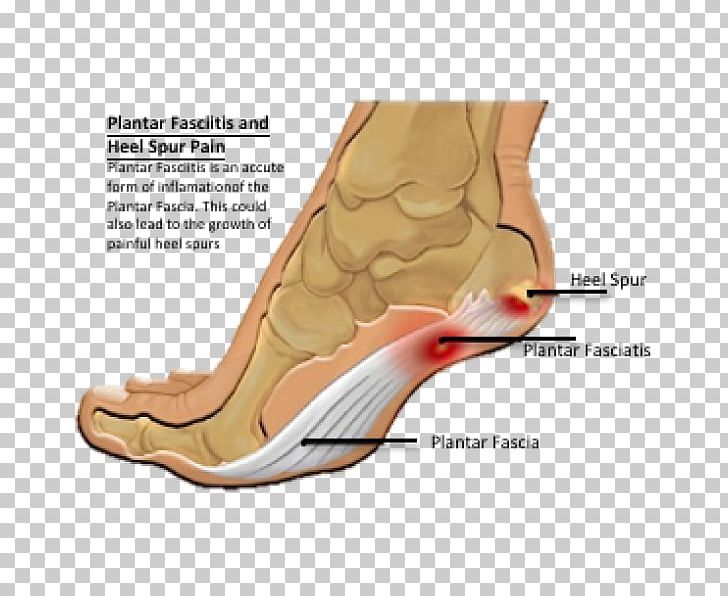 Heel Pain Calcaneal Spur Plantar Fasciitis Foot PNG, Clipart,  Free PNG Download