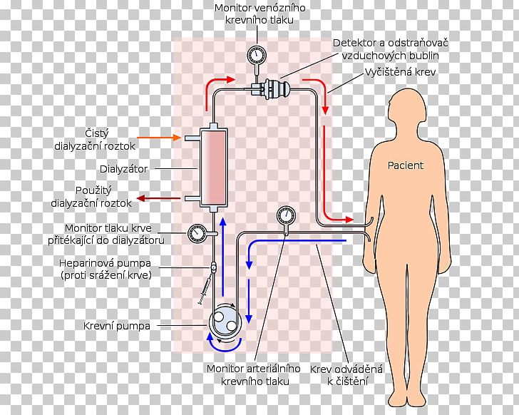 Hemodialysis Chronic Kidney Disease Peritoneal Dialysis PNG, Clipart, Abdomen, Angle, Area, Arm, Blood Free PNG Download