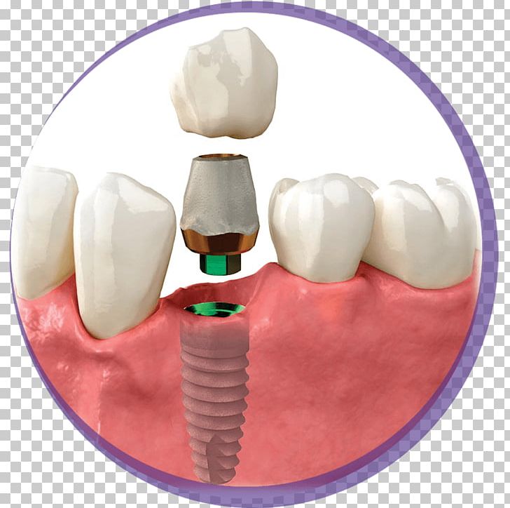 Tooth Dental Implant Crown Zimmer Biomet PNG, Clipart, Ceramic, Crown, Dental Implant, Dental Plaque, Dentist Free PNG Download
