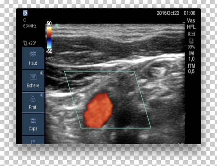 Medical Imaging Carotid Ultrasonography Doppler Echocardiography Ultrasound PNG, Clipart, Biomedical Engineering, Carotid Ultrasonography, Color, Common Carotid Artery, Continuous Monitoring Free PNG Download