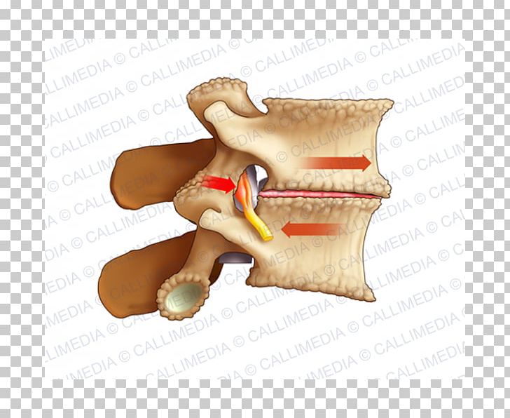 Osteoarthritis Lumbar Vertebrae Pain Arthrodesis Sciatica PNG, Clipart, Anatomy, Arthritis, Arthrodesis, Chronic Pain, Finger Free PNG Download