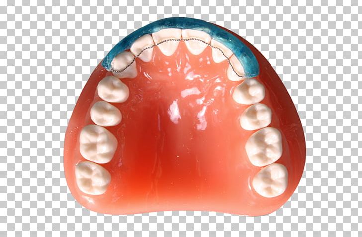 Digital Dentistry Diagnostic Wax-up CAD/CAM Dentistry Tooth PNG, Clipart, Brochure, Cadcam Dentistry, Clinic, Damon, Dental Implant Free PNG Download