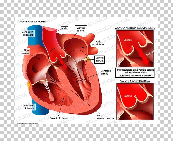 Valvular Aortic Stenosis Aortic Insufficiency Aortic Valve Mitral Insufficiency Mitral Valve PNG, Clipart, Aorta, Aortic Insufficiency, Aortic Valve, Brand, Heart Free PNG Download