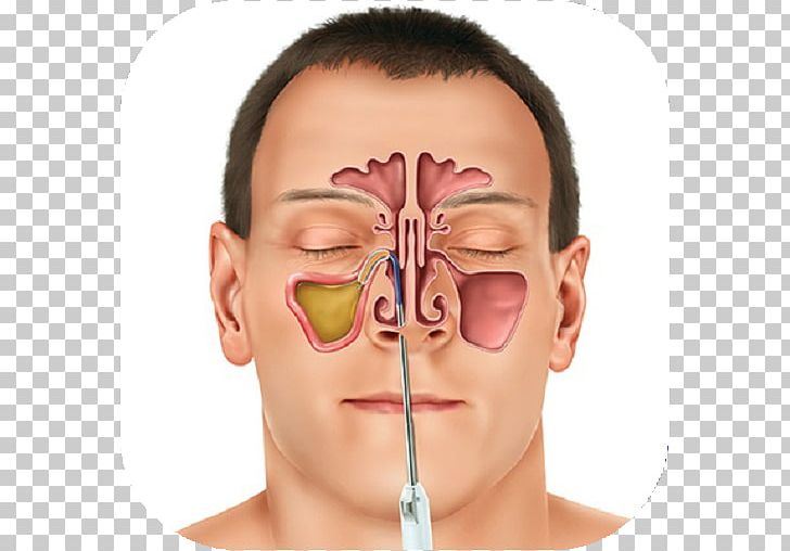 Sinus Infection Paranasal Sinuses Therapy Toothache PNG, Clipart, Ache, Allergy, Antibiotics, Balloon Sinuplasty, Cheek Free PNG Download