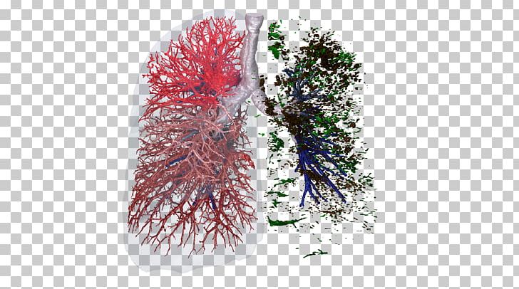 Clinical Trial Lung Respiratory System FLUIDDA Nv Information PNG, Clipart, Algorithm, Artificial Intelligence, Bronchiolitis Obliterans, Clinical Trial, Data Free PNG Download