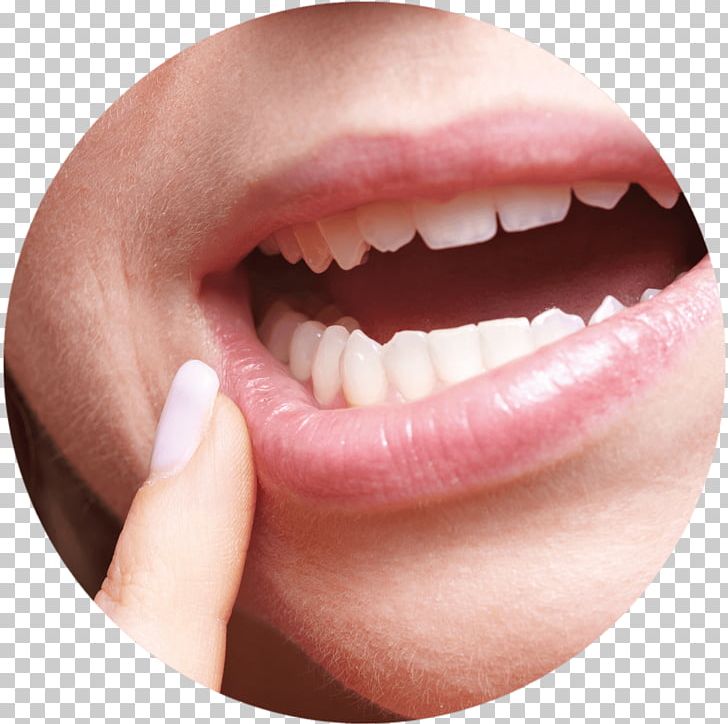 Aphthous Stomatitis Dentistry Mouth Ulcer Gums PNG, Clipart, Aloe Vera, Aphthous Stomatitis, Bleeding On Probing, Cheek, Chewing Gum Free PNG Download