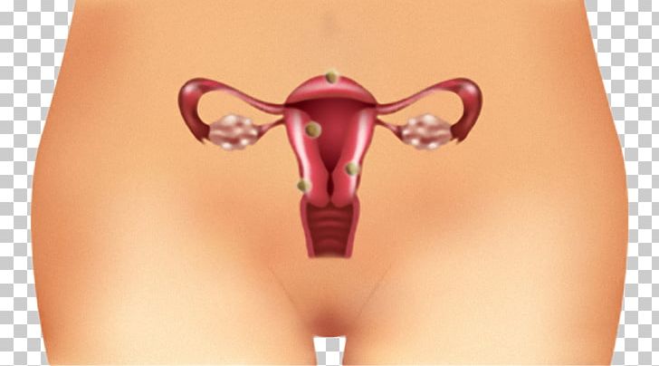 Polycystic Ovary Syndrome Disease Uterine Fibroid PNG, Clipart, Active Undergarment, Benign Tumor, Closeup, Cyst, Disease Free PNG Download