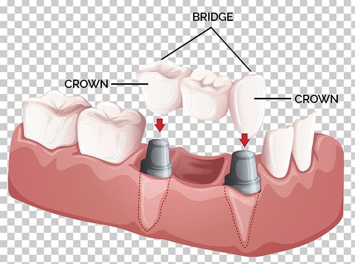Bridge Crown Dentistry Dental Implant PNG, Clipart, Bridge, Cadcam Dentistry, Cosmetic Dentistry, Crown, Dental Implant Free PNG Download