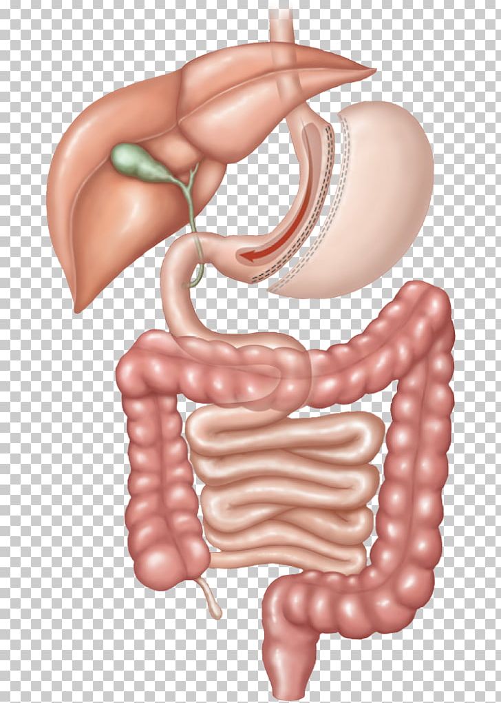 Sleeve Gastrectomy Bariatric Surgery Gastric Bypass Surgery PNG, Clipart, Abdomen, Arm, Band, Bar, Cheek Free PNG Download