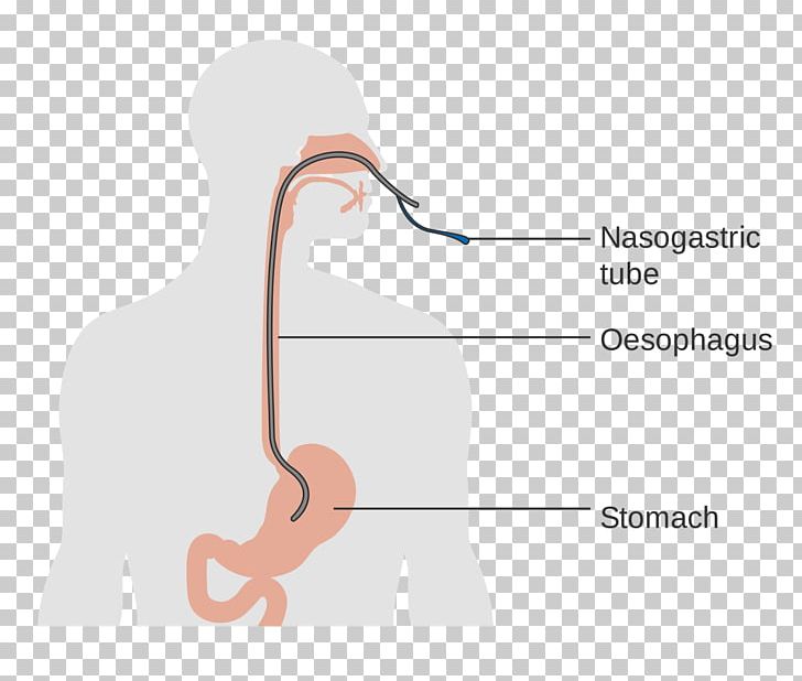 Esophagus Esophageal Cancer Human Anatomy Esophageal Dysphagia Esophagectomy PNG, Clipart, Anatomy, Angle, Communication, Correct Posture Of Baby Feeding, Esophageal Atresia Free PNG Download