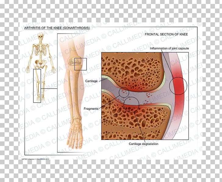 Shoulder Knee Osteoarthritis Knee Arthritis PNG, Clipart, Abdomen, Arm, Arthritis, Arthropathy, Articular Cartilage Damage Free PNG Download