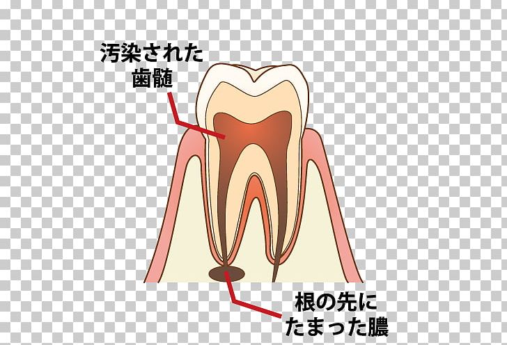 Dentist 歯科 Root Canal Tooth Decay Endodontic Therapy PNG, Clipart, Cure, Dentist, Dentistry, Ear, Endodontic Therapy Free PNG Download