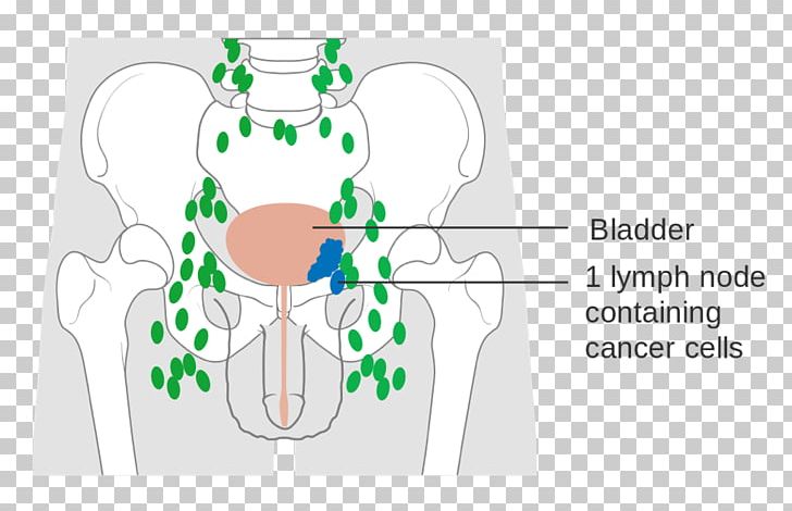 Bladder Cancer Urinary Bladder Cancer Staging Carcinoma PNG, Clipart, Area, Bladder, Bladder Cancer, Cancer, Cancer Research Uk Free PNG Download