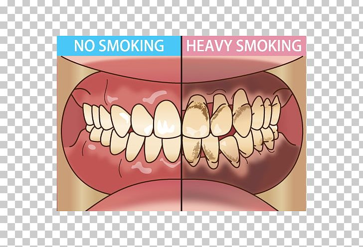Tooth Dentist Periodontal Disease Tobacco Smoking 歯科 PNG, Clipart, Bad Breath, Dental Hygienist, Dentist, East Orlando Dental, Eyelash Free PNG Download