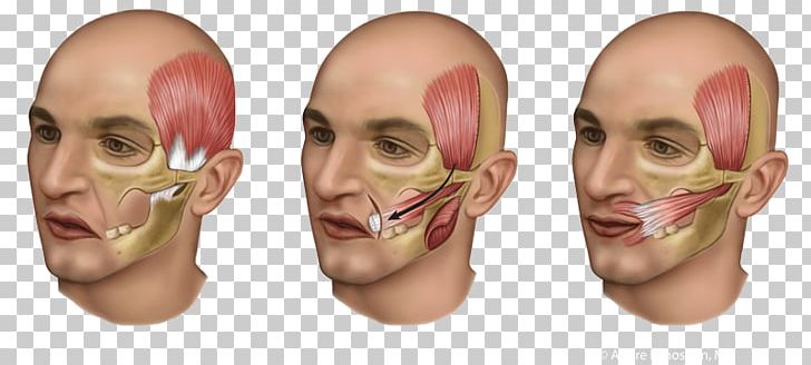 Temporal Muscle Surgery Tendon Buccal Fat Pad PNG, Clipart, Anatomy, Buccal Fat Pad, Cheek, Face, Facial Nerve Paralysis Free PNG Download