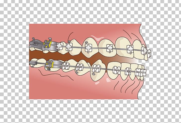 Dentistry 矯正歯科 Dental Braces PNG, Clipart, Angle, Cartoon, Dental Braces, Dental Surgery, Dentist Free PNG Download