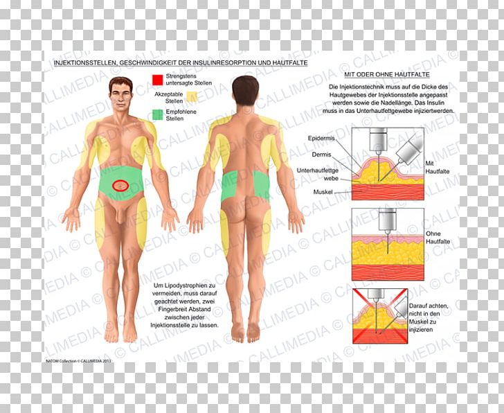 Insulin Subcutaneous Injection Disease Muscle PNG, Clipart, Abdomen, Active Undergarment, Arm, Blood, Blood Sugar Free PNG Download