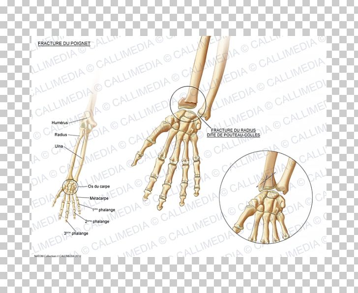 Bone Fracture Carpal Bones Wrist Pisiform Bone PNG, Clipart, Bone, Bone Fracture, Carpal Bones, Carpal Tunnel Syndrome, Fantasy Free PNG Download