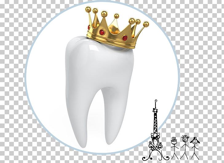 Crown Dentistry Human Tooth PNG, Clipart, Antler, Body Jewelry, Cosmetic Dentistry, Crown, Denplan Free PNG Download