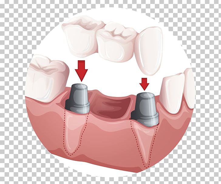 Bridge Dentistry Crown Dental Implant PNG, Clipart, Bridge, Cosmetic Dentistry, Crown, Dental Implant, Dental Restoration Free PNG Download