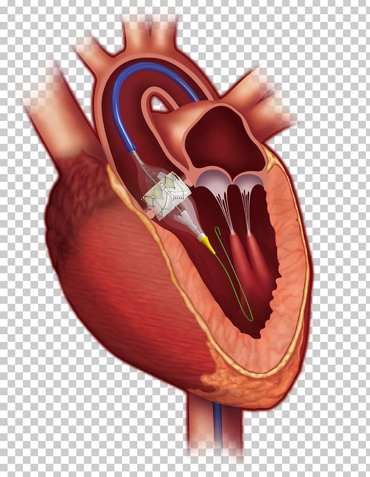 Percutaneous Aortic Valve Replacement Aortic Stenosis Heart Valve PNG, Clipart, Aortic Insufficiency, Aortic Stenosis, Aortic Valve, Aortic Valve Replacement, Cardiac Surgery Free PNG Download