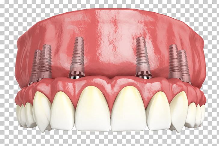 Hybridge Dental Implants Giesy Family And Implant Dentistry PNG, Clipart, Allon4, Bridge, Cosmetic, Crown, Dental Free PNG Download