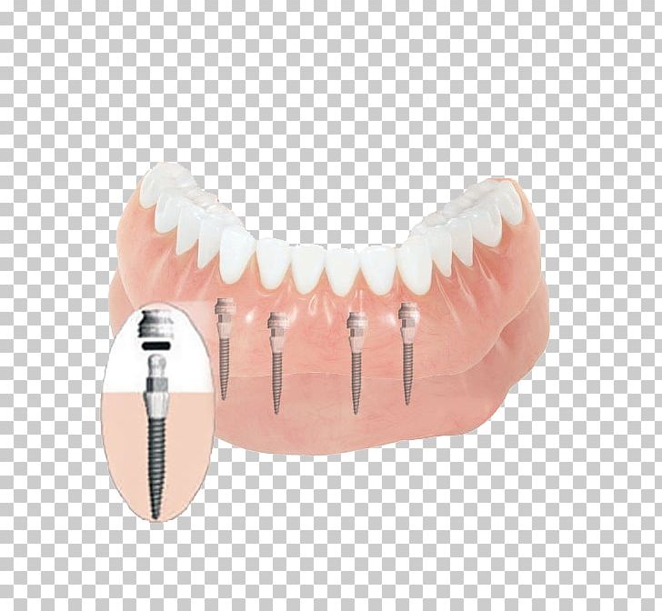 Tooth Dentures Dental Implant Dentistry PNG, Clipart, Bridge, Clinic, Cosmetic Dentistry, Dental, Dental Braces Free PNG Download