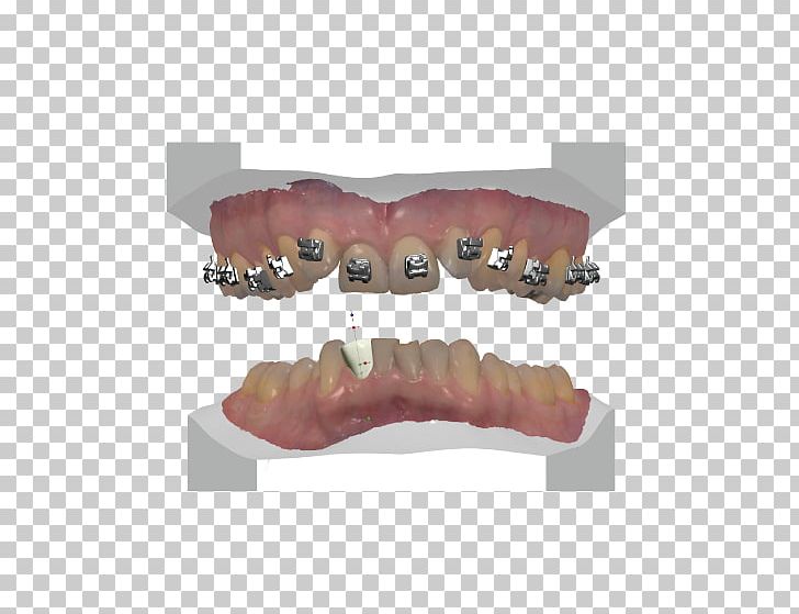 Tooth Dentures Prosthesis Computer-aided Design Computer Software PNG, Clipart, 3d Scanner, 3shape, Art, Computeraided Design, Computer Appliance Free PNG Download