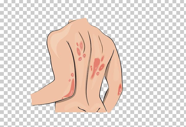 Symptom Systemic Lupus Erythematosus Allergy Psoriasis Skin PNG, Clipart, Abdomen, Allergy, Anime, Arm, Cartoon Free PNG Download