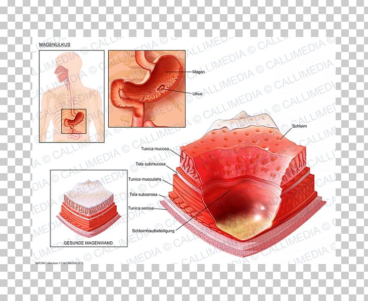 ＴＭＣ三鷹健診センター Peptic Ulcer Disease Skin Ulcer Inflammation Gastritis PNG, Clipart, 360 Degrees, Disease, Gastric Acid, Gastric Mucosa, Gastritis Free PNG Download