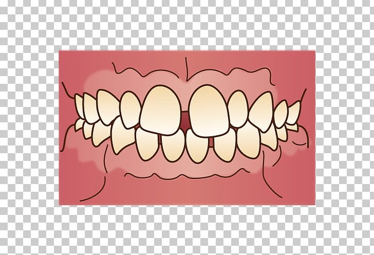 Prognathism Crossbite Malocclusion 歯科 Dentist PNG, Clipart, Alaleuanluu, Bruxism, Crossbite, Dental Braces, Dentist Free PNG Download
