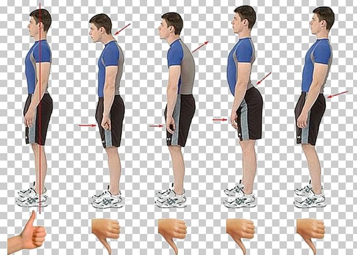 Scoliosis Poor Posture Neutral Spine Physical Therapy PNG, Clipart, Abdomen, Arm, Back Brace, Balance, Calf Free PNG Download
