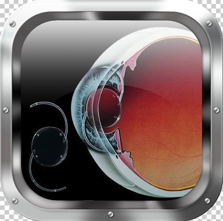 Intraocular Lens Retinal Detachment Cataract Surgery PNG, Clipart, Anterior Chamber Of Eyeball, App, Audio, Calculator, Cataract Free PNG Download