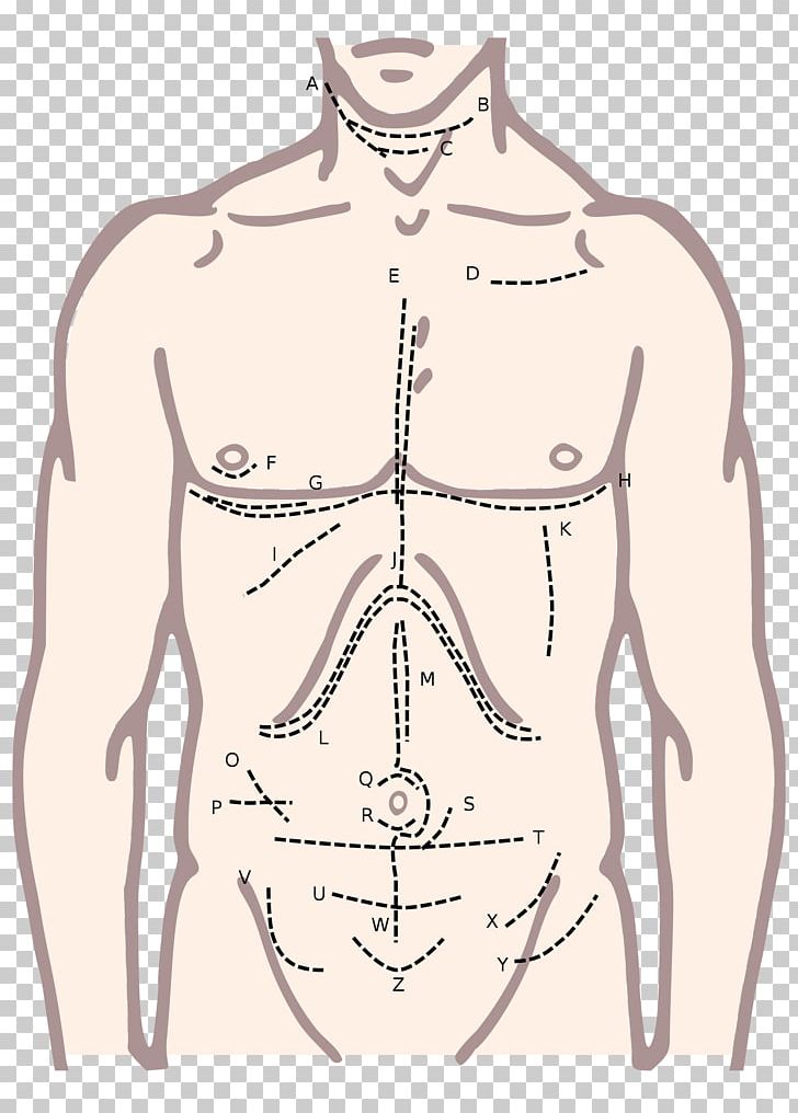 Surgical Incision Surgery Xiphoid Process McBurney's Point Median Sternotomy PNG, Clipart,  Free PNG Download