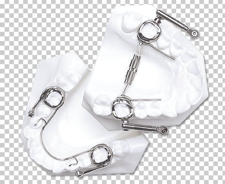 Orthodontics The Herbst Appliance Orthodontic Technology Tooth Mandible PNG, Clipart, Appliances, Body Jewelry, Computer Appliance, Face, Fashion Accessory Free PNG Download