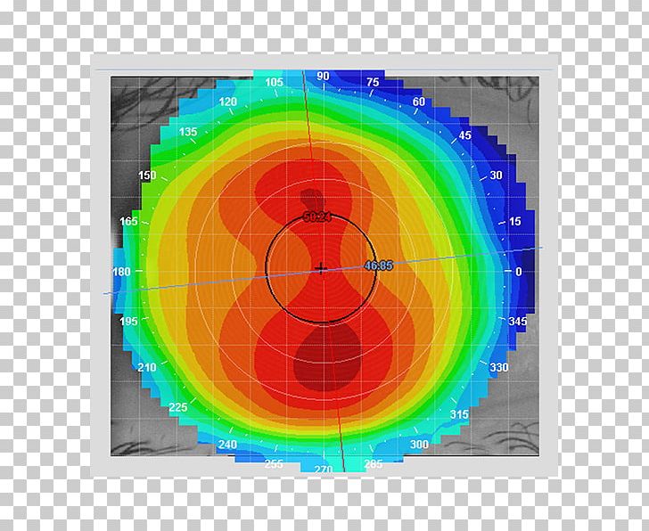 Corneal Topography Keratoconus Contact Lenses Optometry PNG, Clipart, Circle, Contact Lenses, Cornea, Corneal Topography, Curvature Free PNG Download