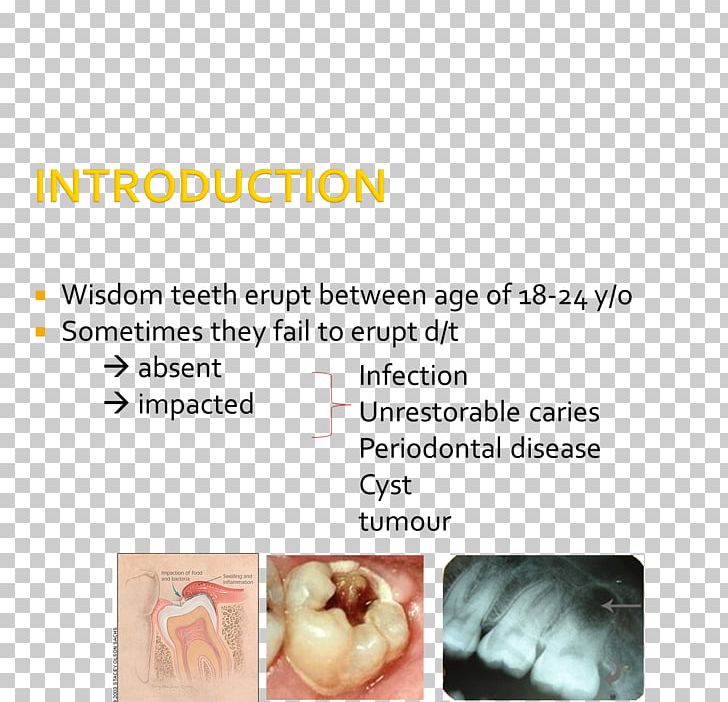 Wisdom Tooth Impacted Wisdom Teeth Tooth Impaction Jaw Molar PNG, Clipart, Far Infrared, Heat, Impact, Impacted Wisdom Teeth, Infrared Free PNG Download