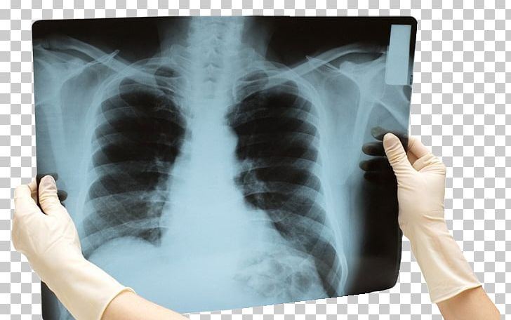Rib Health Surgery Lung Physician PNG, Clipart, Bone, Chest, Disease, Hand, Health Free PNG Download