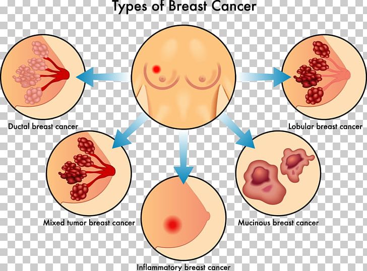 Inflammatory Breast Cancer Invasive Lobular Carcinoma PNG, Clipart, Breast, Breast Cancer, Breast Cancer Management, Breast Lump, Disease Free PNG Download