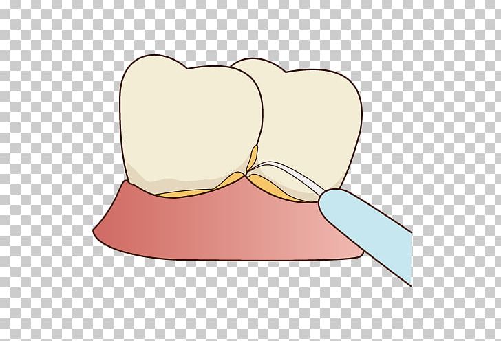 Tooth Decay 歯科 Dentist Periodontal Disease PNG, Clipart, Dental Calculus, Dental Implant, Dentist, Heart, Jaw Free PNG Download