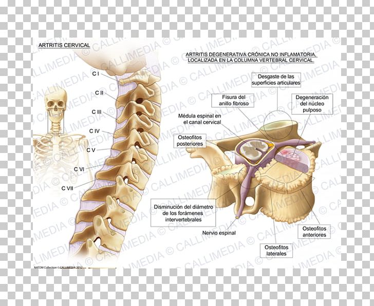 Cervical Osteoarthritis Cervical Vertebrae Vertebral Column PNG, Clipart, Arthritis, Bone, Cervical Vertebrae, Chronic Condition, Chronic Pain Free PNG Download