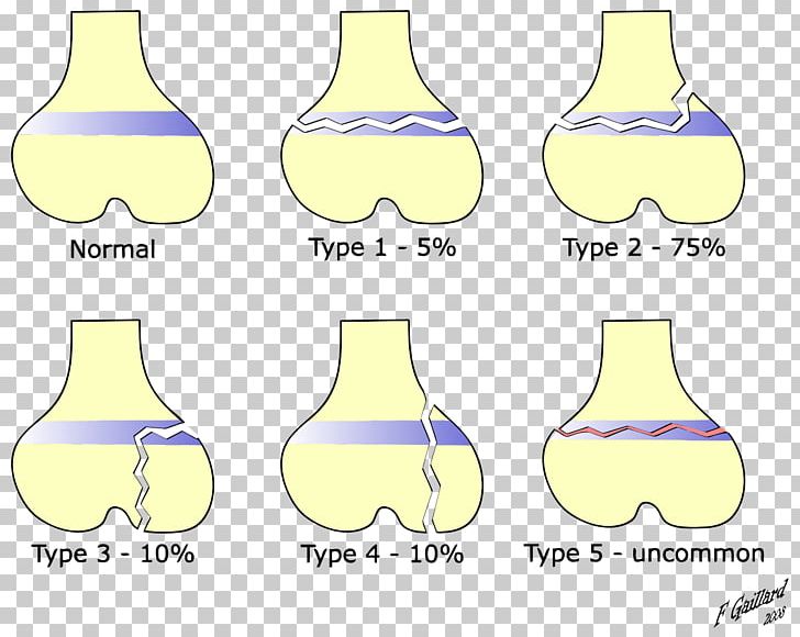 Salter–Harris Fracture Bone Fracture Epiphyseal Plate Ankle Fracture Metaphysis PNG, Clipart, Ankle Fracture, Area, Bone Fracture, Distal Radius Fracture, Epiphyseal Plate Free PNG Download