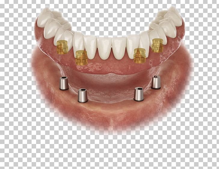 Abutment Dental Implant Prosthesis Dental Laboratory Dentures PNG, Clipart, Abutment, Allon4, Atlantis, Bridge, Cadcam Dentistry Free PNG Download